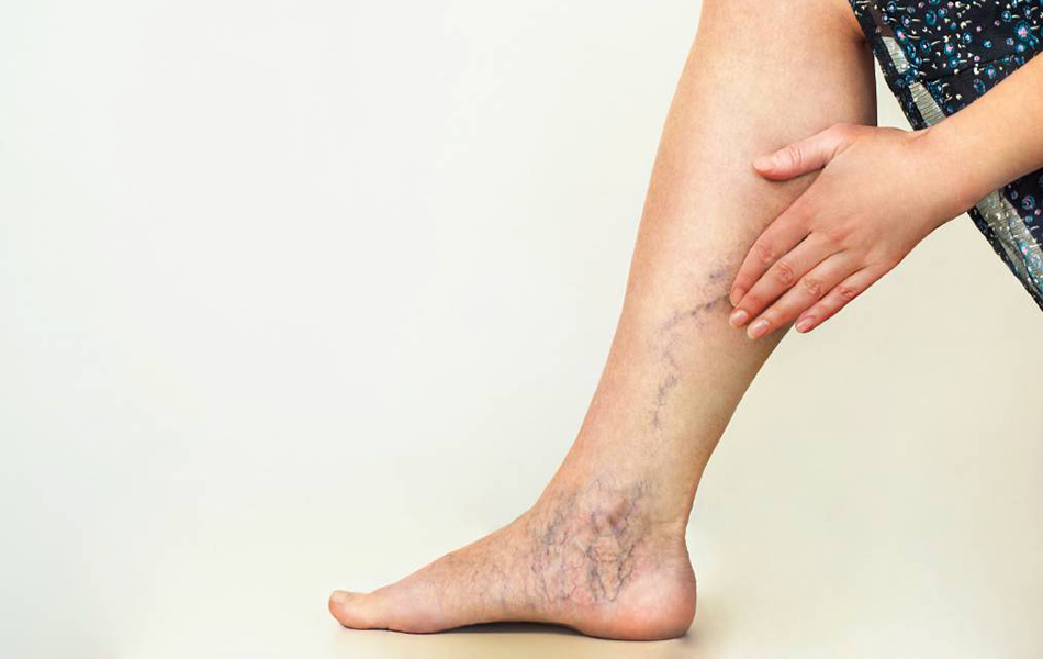 A lábak megakadályozzák a visszér kialakulását, Lymph Aktív 2.0